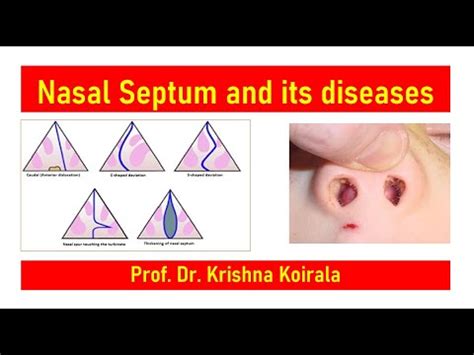 Deviated Nasal Septum Dns Septal Hematoma Septal Perforation Dr Krishna S Ent Lectures