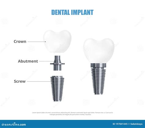 Ilustración Vectorial 3d Realista De La Estructura Del Implante Dental