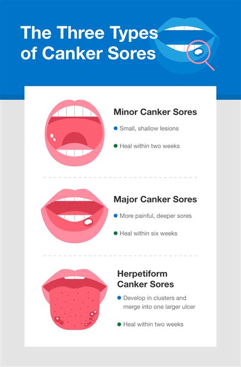 What Causes Canker Sores And How To Get Rid Of Them Smartmouth