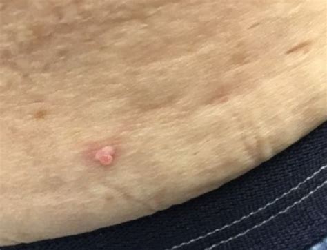 Derm Dx Flesh Colored Polypoid Lesion On The Abdomen Dermatology