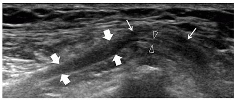Ultrasound Guided Lateral Femoral Cutaneous Nerve Block Anesthesia Key