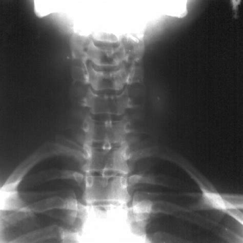 X Ray Showing Bilateral Cervical Ribs Download Scientific Diagram