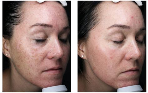 Halo Laser Before And After Blush Aesthetics