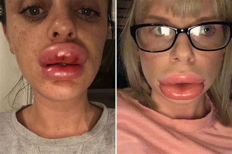 When Botox And Lip Fillers Go Wrong 20 Pics Club Giggle