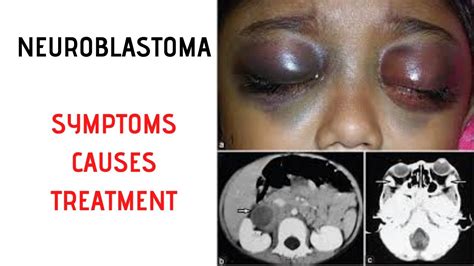 Neuroblastoma Symptoms Signs Causes Treatment Youtube