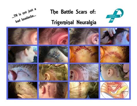 The Surgical Options For Trigeminal Neuralgia Include Peripheral Nerve