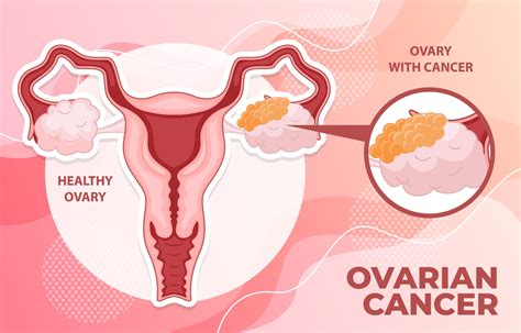Ovarian Cancer Infographic 3095859 Vector Art At Vecteezy