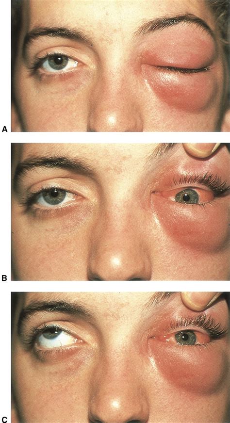 Orbital Cellulitis American Academy Of Ophthalmology