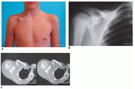 Congenital Pseudarthrosis Of The Clavicle Musculoskeletal Key