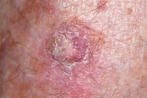 Squamous Cell Carcinoma Skin Cancer Stock Image C Science Photo Library