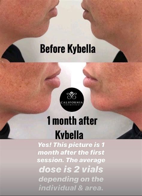 Kybella® Injections And Treatment Double Chin Removal Jowls Stomach