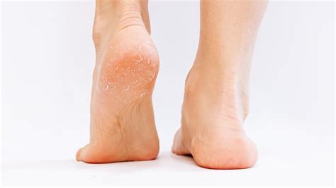 Is Your Workout To Blame For Peeling Feet
