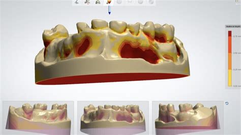 Full Digital Flexibles Hughes Dental Laboratory