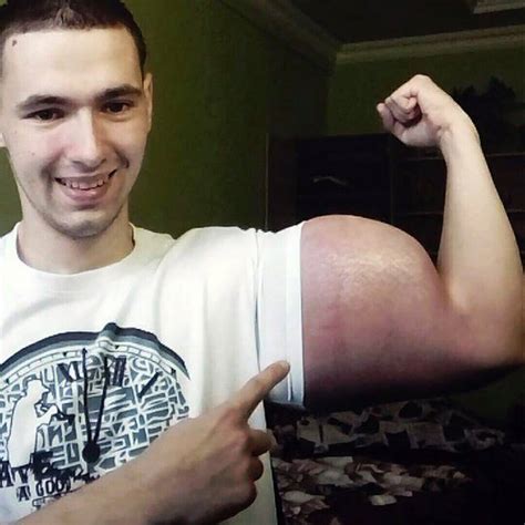 Man With Huge Popeye Arms Could Lose Them According To Doctors