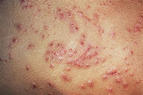 Characterizing Staphylococcus Aureus Colonization During Eczema Disease