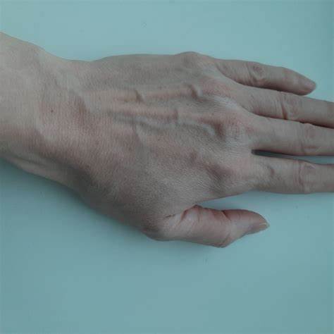 Варикоз рук? - Вопрос флебологу - 03 Онлайн Картинка - Варикоз рук? - Вопрос флебологу - 03 Онлайн