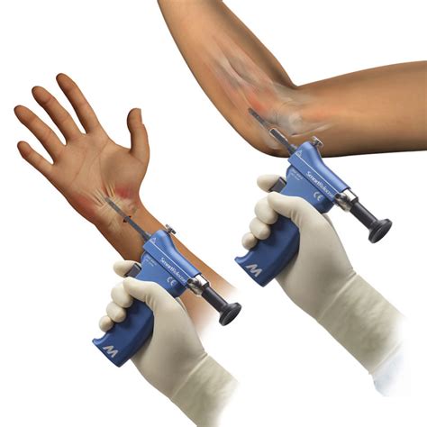 Smartrelease Endoscopic Carpal And Cubital Tunnel Release By Microaire