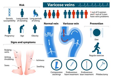 Varicose Veins Treatment How To Get Rid Of Varicose Veins Flawless