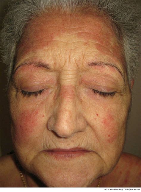 Yellow Skin Discoloration Induced By Quinacrine In A Patient With