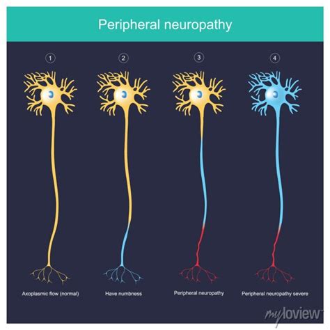 Peripheral Neuropathy Explain Illustration For The Peripheral Posters
