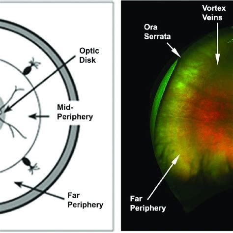 Drusen In Peripheral Retina In Comparison To Macula Retina Is