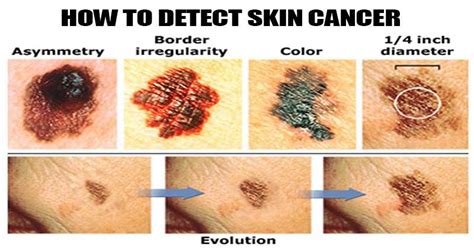 Early Signs Of Skin Cancer Kinds Of Skin Cancer Kulturaupice