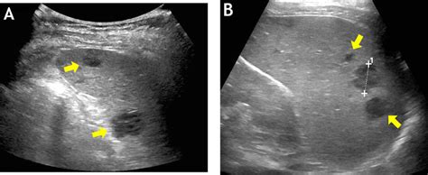 A And B Focal Splenic Lymphoma Involvement In A 6 Years Old Male