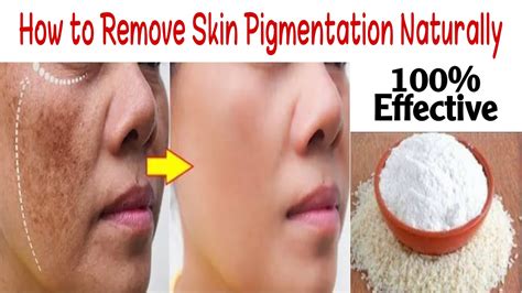 How To Remove Skin Pigmentation How To Get Rid Dark Spots Melasma