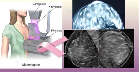 Mammogram For Dense Breasts Things You Must Know