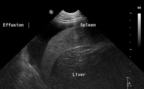 Ultrasonography Of Peritoneal And Retroperitoneal Spaces And Abdominal