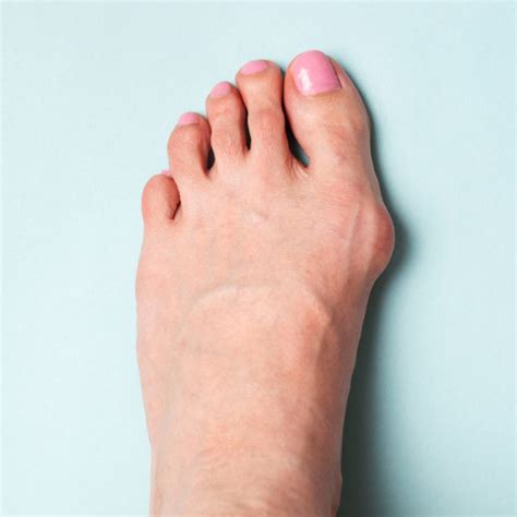 Causes And Treatment Of Bunions Pt 2 West Suburban Pain Relief