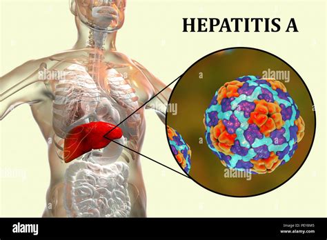 Hepatitis A la infección Equipo ilustración mostrando el hígado y una