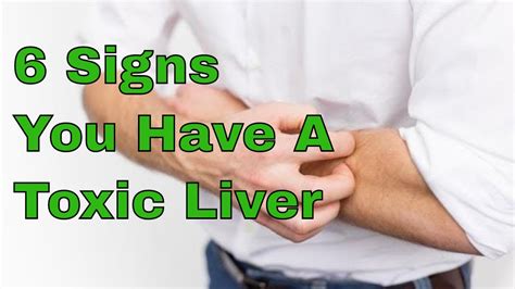 6 Signs You Have A Toxic Liver Youtube