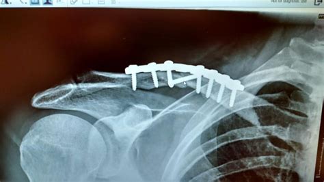 Pins Needles And Pain One Year After A Broken Collarbone