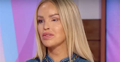 Loose Women Star Katie Piper Hospitalised For Eye Surgery