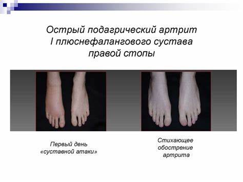 Подагрический артрит какая диета Подагрический артрит какая диета