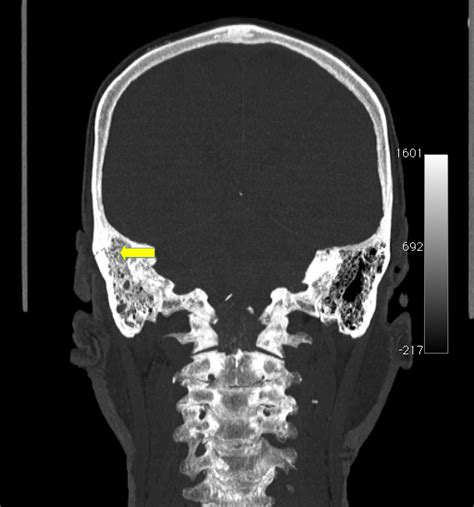 Longitudinal temporal bone fracture | Image | Radiopaedia.org