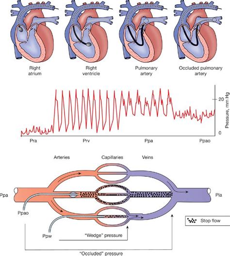 Pulmonary Artery Pressure Values