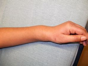 Woman With Left Wrist Pain Annals Of Emergency Medicine