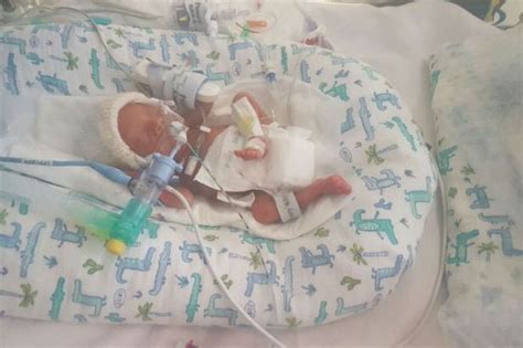 Miracle Baby Born 17 Weeks Early With Paper Thin Skin Will Be Home In