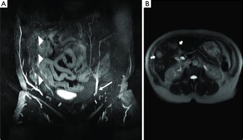 Right Deep Inferior Epigastric Artery Was Injured During Prior Surgery
