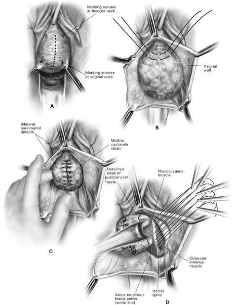 Figure 1 From Anatomic And Functional Outcome Of Vaginal Paravaginal Repair In The Correction Of