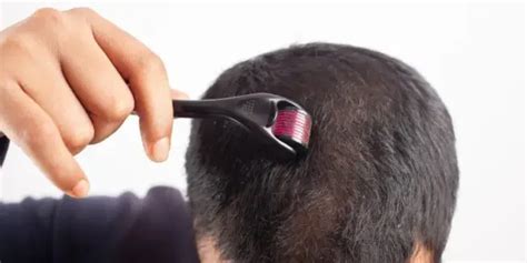 10 Best Treatments For Balding In Men