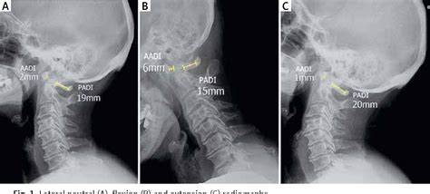 Figure 1 From Cervical Spine Instability In The Course Of Rheumatoid