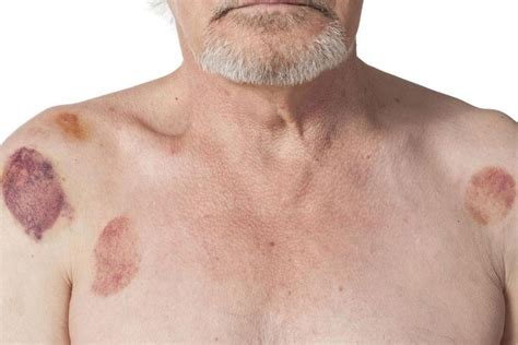 How To Effectively Treat Hematomas At Home