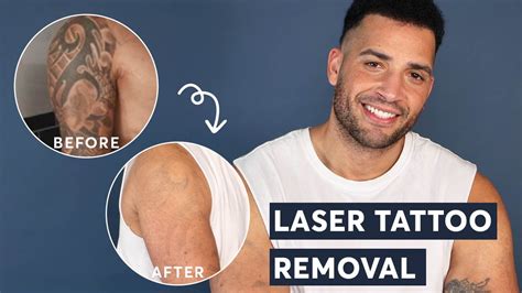 Top 100 Tattoo Removal Before And After Photos Monersathe