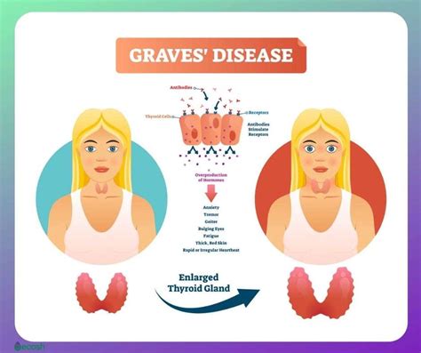 The Natural Management Of Graves Disease Pharmacopathy