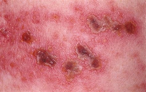 Shingles Rash Pictures: What does Shingles look like?