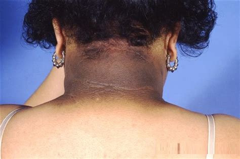 Acanthosis Nigricans Pictures Causes Treatment Cure Symptoms
