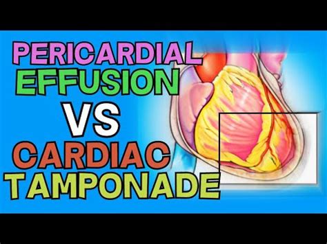 PERICARDIAL EFFUSION Vs CARDIAC TAMPONADE EXPLAINED IN 5 MINUTES